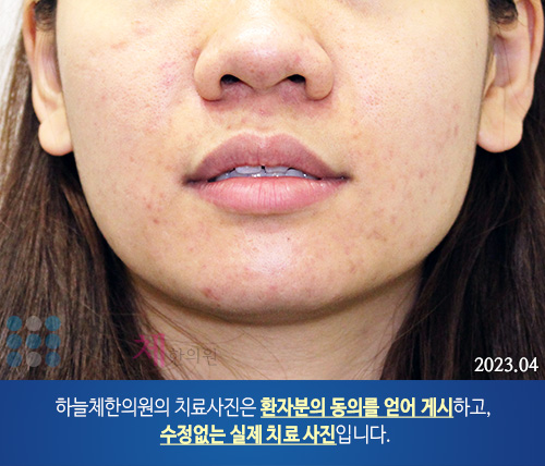 얼굴여드름