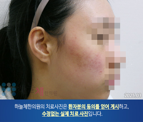 얼굴여드름