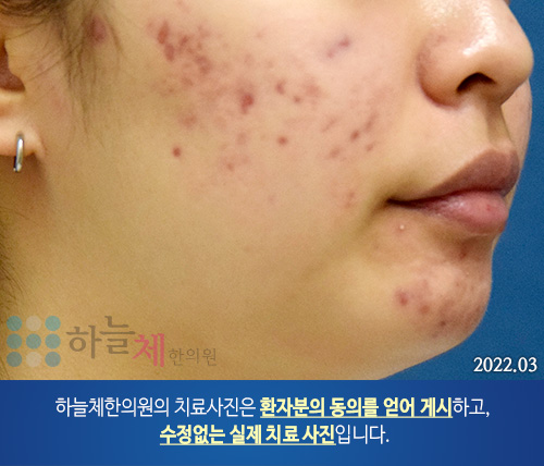 여드름흉터/자국