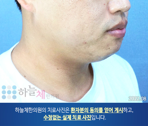 여드름흉터/자국