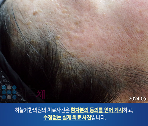 피부질환