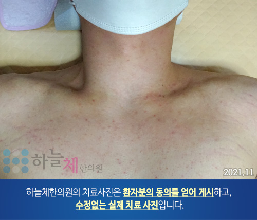 몸여드름