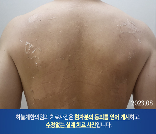 몸여드름