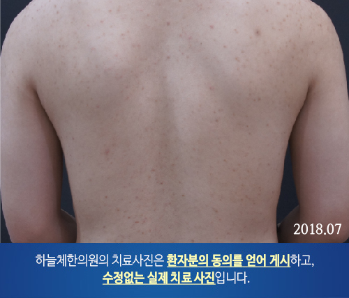 몸여드름
