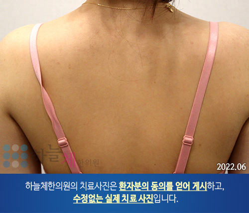 몸여드름