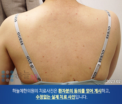몸여드름